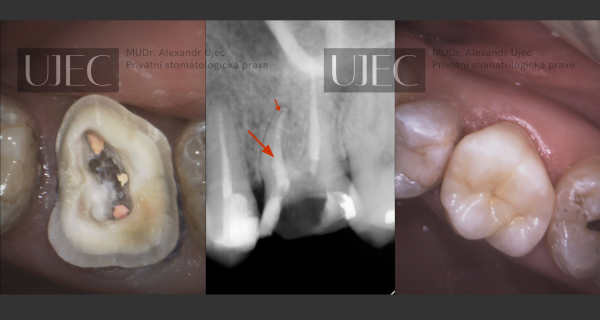 Zleva: zaplněný kanálek (v horní části zubu na obrázku); RTG snímek s novou hermetickou výplní (šipky); nová e.max celokeramická korunka